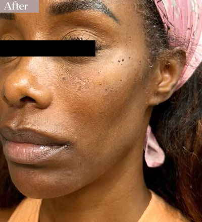cheek filler enhacement after